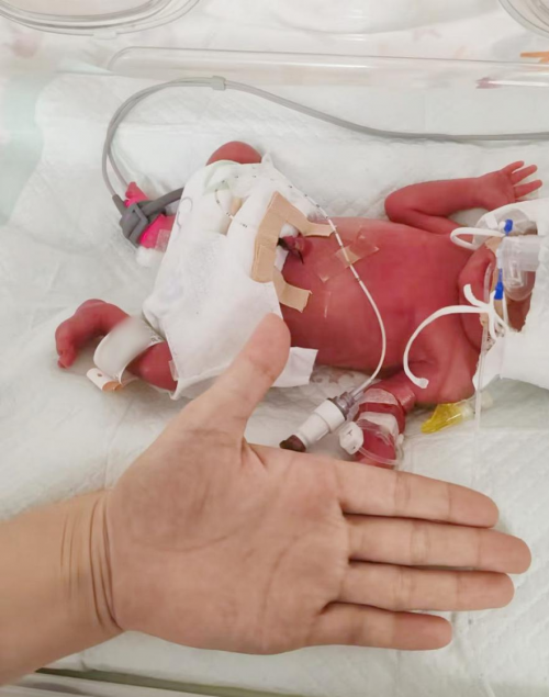历时69天！河北生殖妇产医院新生儿科成功救治一对28+1周早产“巴掌”宝宝